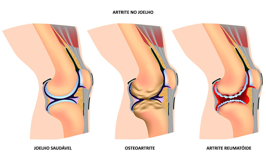iconografia de um joelho com artrite e um saudável