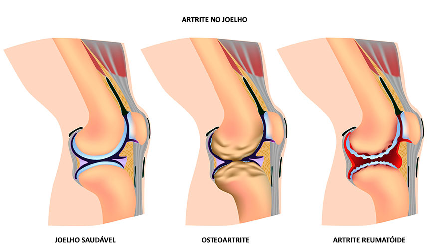 Quem tem osteoartrite deve evitar subir muitos lances de escada? –  EncontrAR – GRUPAR