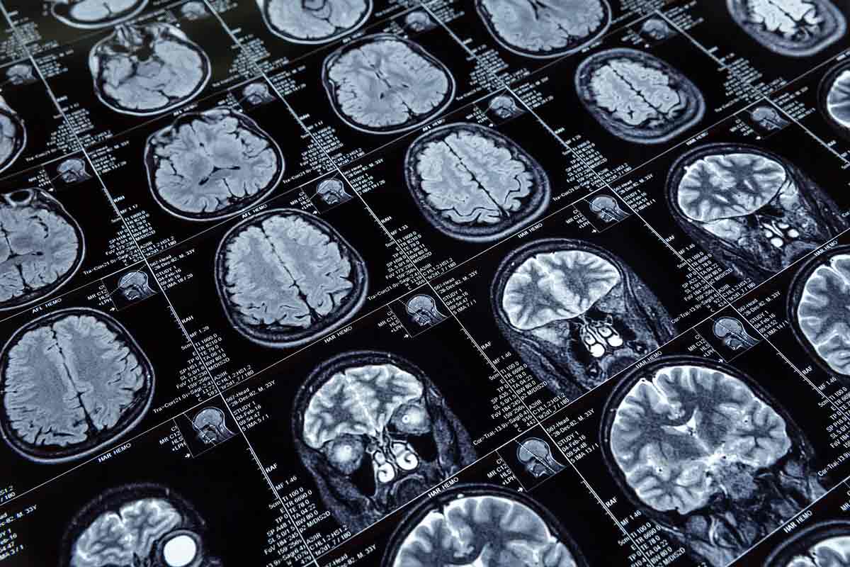 Doença de Alzheimer radiografia do cérebro